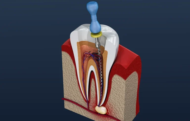 Happy Teeth: ‘ரூட் கனால்’ சிகிச்சை யாருக்கெல்லாம் தேவை?