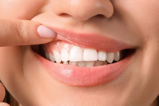 Oral health | பற்களை ஒழுங்காக பராமரிக்காவிட்டால் நோய் கிருமிகள் தாக்கலாம்.. உஷார்..!